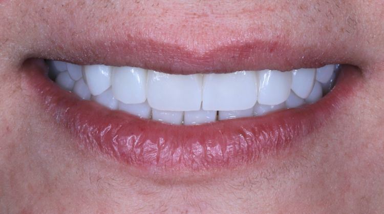 After -Wash Common Dental