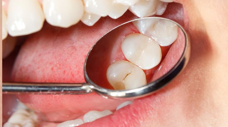 After -Wash Common Dental