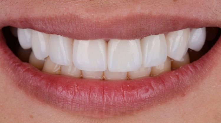 After -Wash Common Dental 